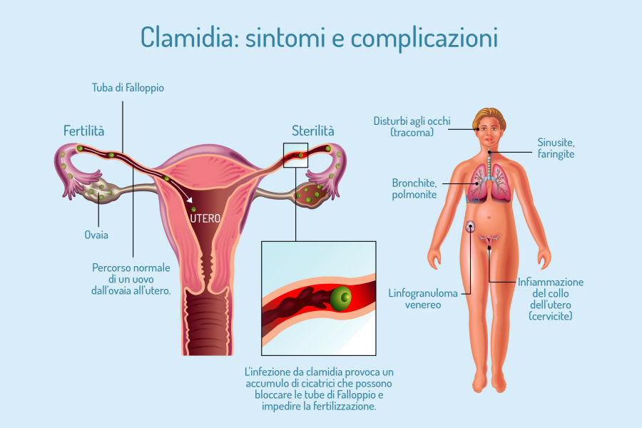 La Clamidia (Chlamydia trachomatis)