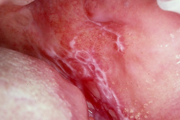 Lichen planus orale, disordine infiammatorio cronico delle mucose all&#039;interno della bocca