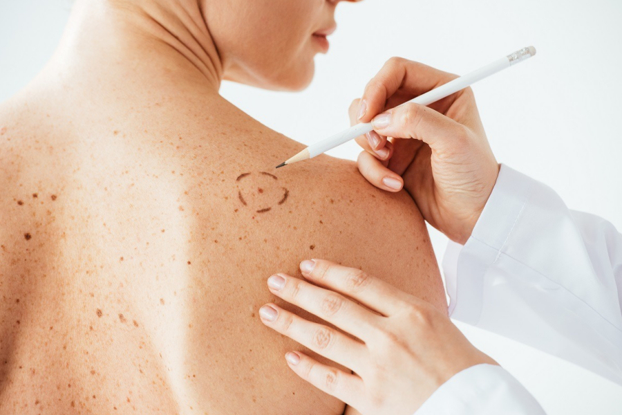 Maggio è il mese della prevenzione del melanoma cutaneo: perché fa così paura, come intervenire?