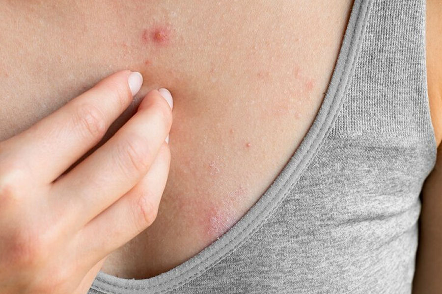 Dermatite atopica, cause, sintomi